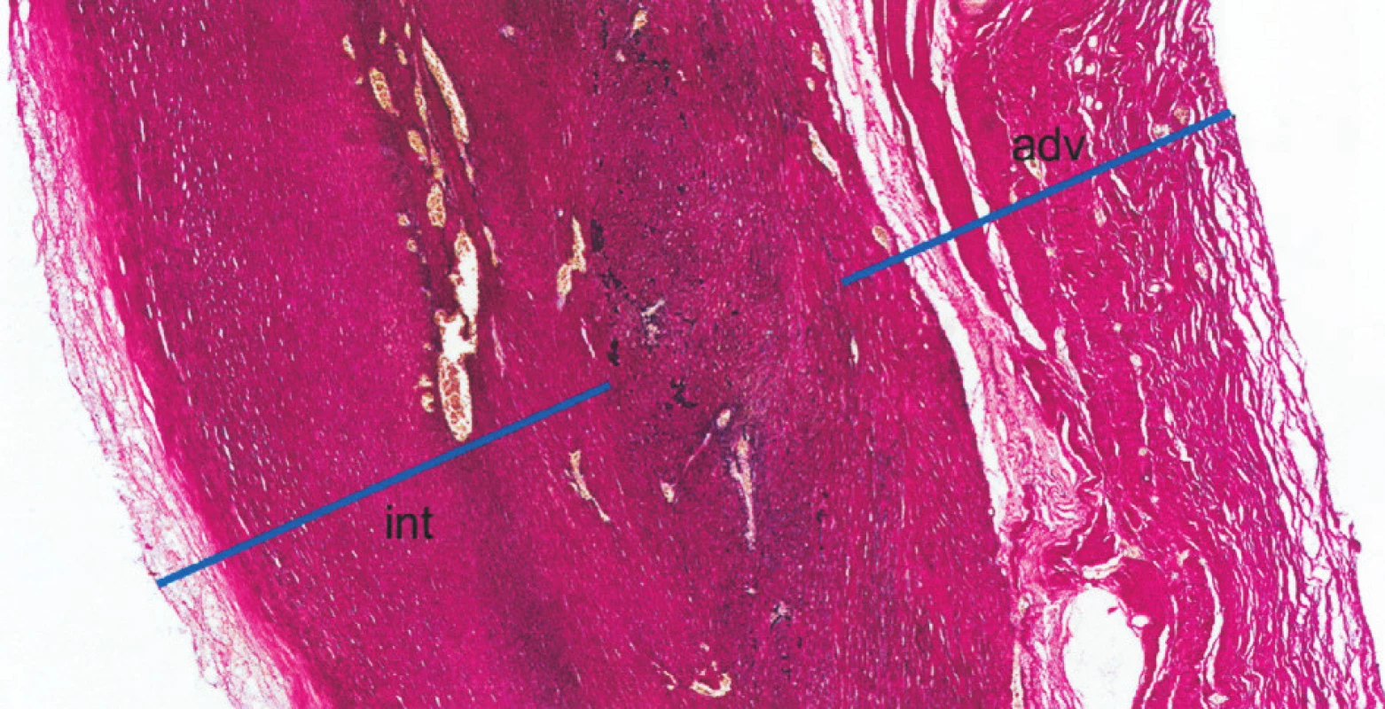 Histologie: Histotopogram resekované části stěny vzestupné aorty (barvení elastika – van Gieson). Stěna je výrazně ztluštělá, zejména fibrózním ztluštěním intimy (int) a adventicie (adv); mezi nimi je zjizvená, atrofická médie, s jen zbytky elastické složky (fragmenty černých hrubých vláken). Médie i intima jsou vaskularizované. Jde o obraz pozdního, jizevnatého stadia choroby, již bez nekróz a bez zánětlivých infiltrátů
Fig. 4. Histology: A histotopographic study of the resected part of the ascending aortic wall (elastic – van Gieson stain). The wall is significantly thickened, in particular due to fibrous intimal (int) and adventitial (adv) thickening; the inbetween media is scarred and atrophic, with remnants of the elastic component (fragments of black coarse fibres). The media and intima layers are vascularized. The above is a picture of late, scarring disease stage, already without necroses and inflammatory infiltrations