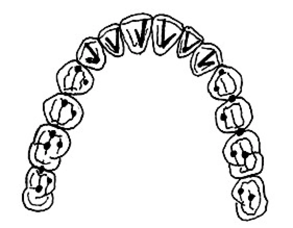 Ideální kontakty ve statické a dynamické okluzi podle Dawsona: „tečky vzadu, linky vepředu“. Tečky na laterálních zubech značí, že na laterálních zubech jsou pouze kontakty v maximální interkuspidaci (která je ve shodě s centrálním vztahem). Linky vepředu značí úkol frontálních zubů diskludovat laterální zuby u všech exkurzí. Hlavním úkolem předního vedení je chránit laterální zuby. (Obrázek převzat a upraven z knihy Dawson, P. E.: Functional occlusion: From TMJ to Smile Design. Mosby, 2007. ISBN 978-0-323-03371-8 [6].)