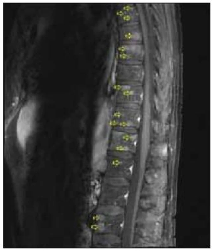 Sagitální řez z MRI (T2 STIR), šipky označují ložiskové postižení obratlů.