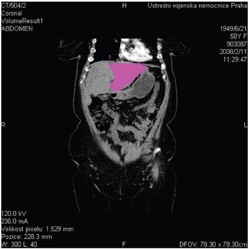 CT volumetrie s měřením objemu levého jaterního laloku
Fig. 5: CT volumetry of the left liver lobe