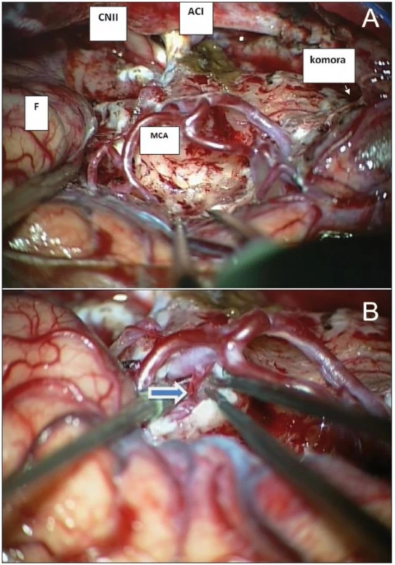 A. Ozřejmení základních anatomických struktur během resekce insulárního gliomu Yaşargilova typu 5B.
B. Odstup LLsA vypreparovaný během resekce inzulárního gliomu (šipka).
F: frontální lalok; MCA: větvení arteria cerebri media; CN II: nervus opticus; ACI: arteria cerebri interna; komora: temporální roh postranní komory (meziotemporální struktury a temporální lalok resekovány)
