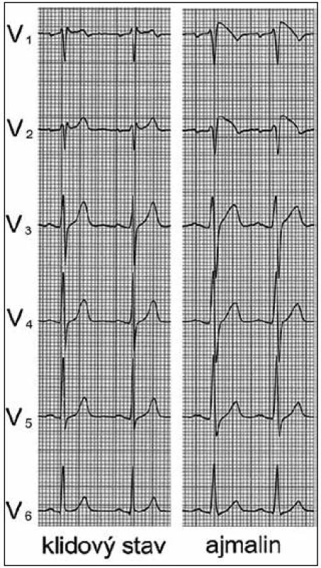 Ukázkové EKG pacienta se sedlovitým uspořádáním elevace ST ve svodech V&lt;sub&gt;1&lt;/sub&gt; a V&lt;sub&gt;2&lt;/sub&gt; v klidovém stavu, které se po aplikaci ajmalinu změnilo ve vyklenutý typ. S dovolením převzato z citace [73].