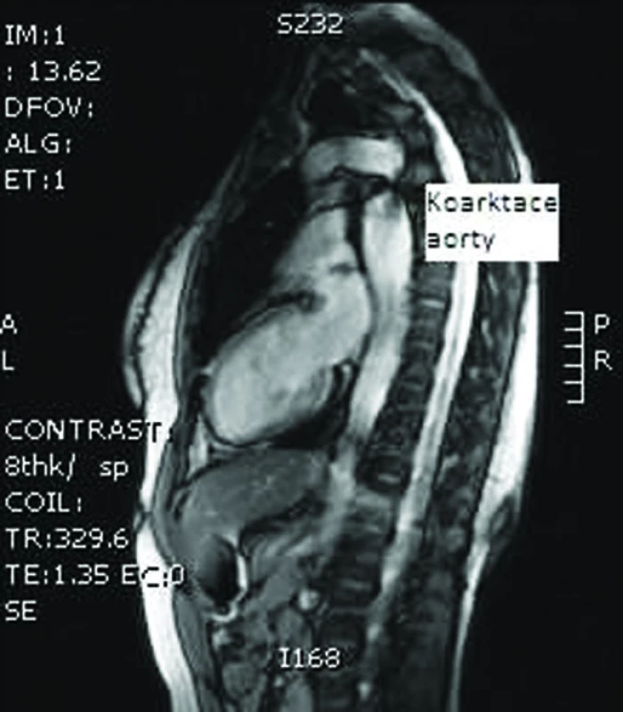 MRI hrudní aorty – koarktace aorty nově diagnostikovaná u 29leté pacientky před IVF (archiv autorů).