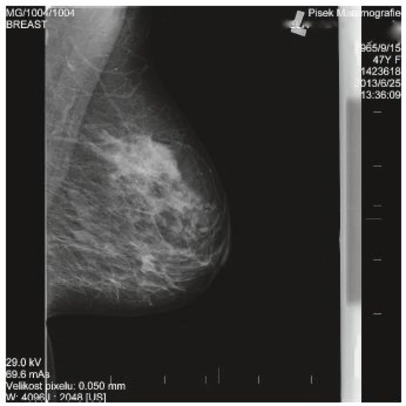 Mamografický obraz L prsu