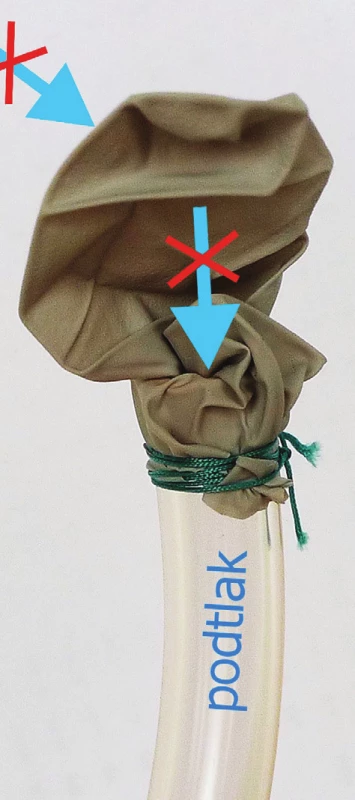 Princip funkce Heimlichovy chlopně a) výdech – vzduch uniká otvorem blízko vrcholu chlopně; b) nádech – podtlak způsobí kolaps chlopně, a tedy uzavření otvoru.
Fig. 3: Principle of the Heimlich valve a) expiration – air goes out through a small opening near the valve top, b) inspiration – the negative pressure causes the collapse of the valve and occlusion.