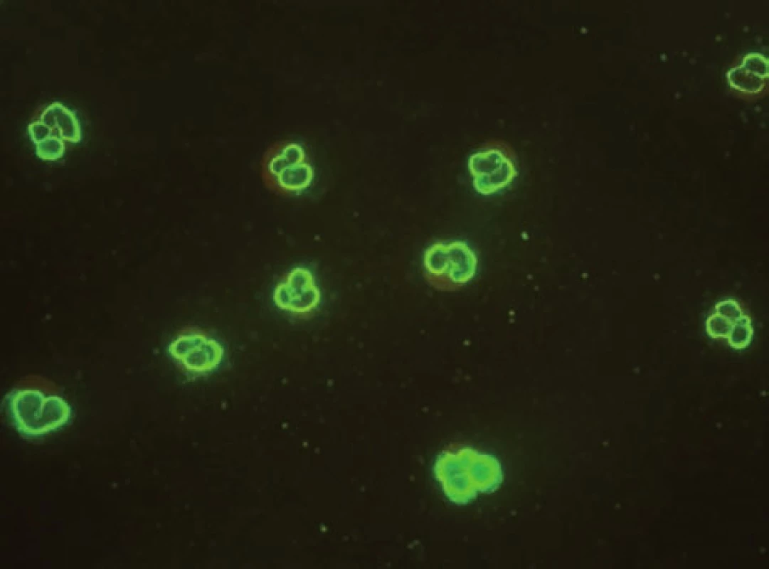 Imunofluorescenční obraz ANCA protilátek perinukleárního typu na lidských granulocytech fixovaných etanolem.
Fig. 4. Immunofluorescent image of anti-neutrophil cytoplasmatic antibodies of perinuclear type on human granulocytes fixed with ethanol.