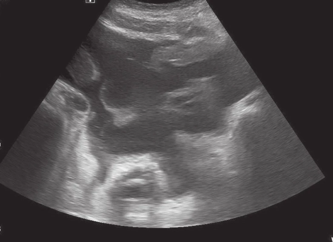 Ultrasonografický nález volné tekutiny v dutině břišní
Fig. 1: Ultrasonographic finding of loose fluid in the abdominal cavity
