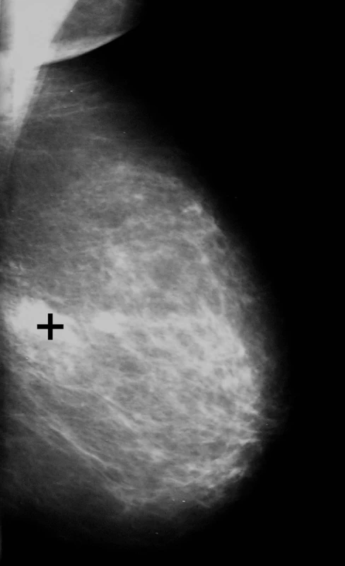 Mamografický snímek levého prsu v mediolaterální šikmé projekci s ložiskem duktálního invazivního karcinomu, které je označeno černým křížkem (stejná pacientka jako na obrázku 6, kde je přítomna neovaskularizace k tomuto malignímu nádoru)