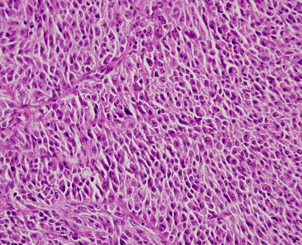 Maligní melanom uvey v přehledném barvení hematoxylinem- eosinem