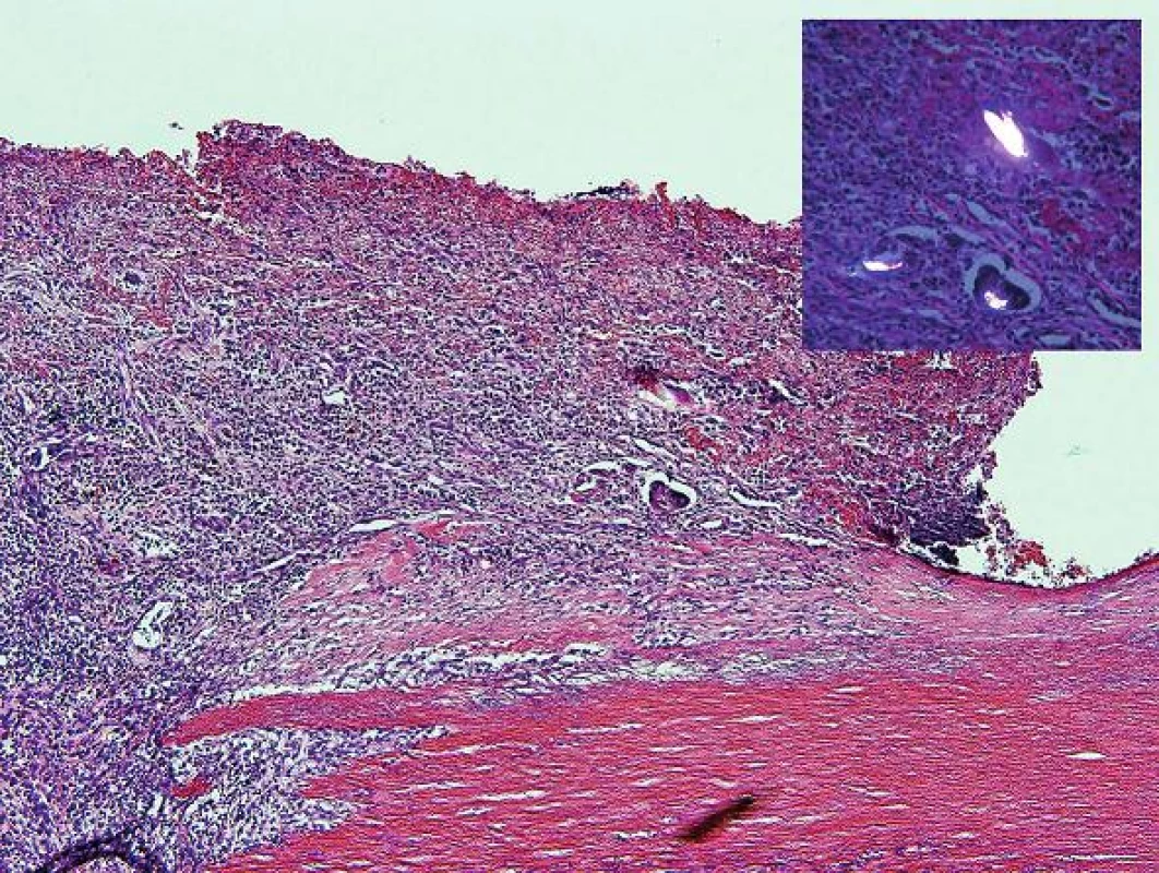 Oblasť endotelu aorty v blízkosti perforácie s prítomnosťou mnohojadrových buniek z cudzích telies obsahujúcich dvojlomný materiál (vložený obrázok) (hematoxylín-eozín, zväčšenie 100x).