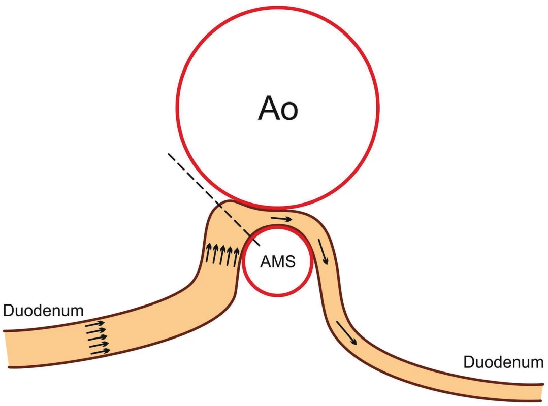 Schematické znázornění abnormální morfologie syndromu horní mezenteriální arterie.
Fig. 1. Abnormal morphology in superior mesenteric artery syndrome.