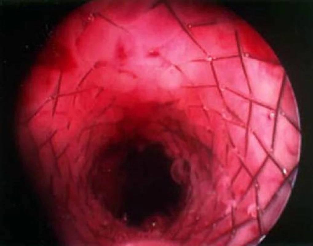 UroLume stent umístěný v prostatě.