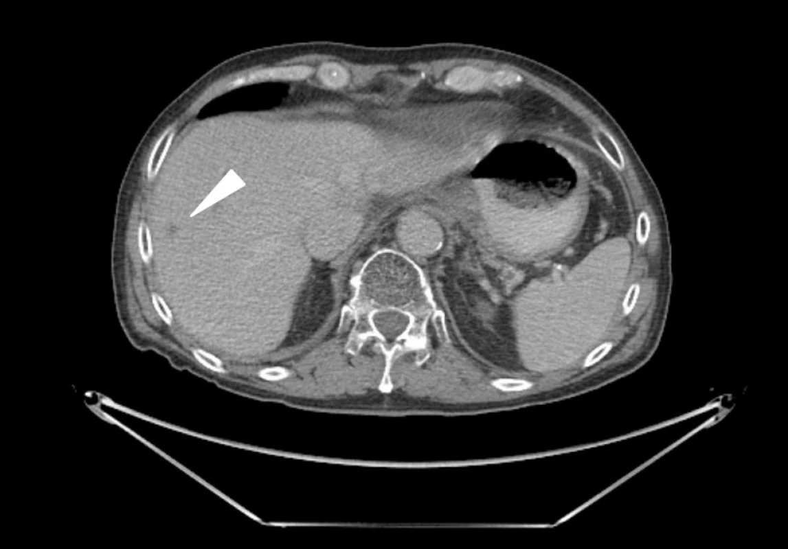 CT vyšetření břicha: v pravém jaterním laloku na hranici S VII/VIII je asi 2 cm velké, hypodenzní, subkapsulárně uložené ložisko odpovídající metastáze adenokarcinomu žaludku (šipka)
Fig. 1: Abdominal CT scan: liver metastasis of gastric cancer – tumour of 2 cm in size in the right lobe of the liver – segment VII/VIII (arrow)