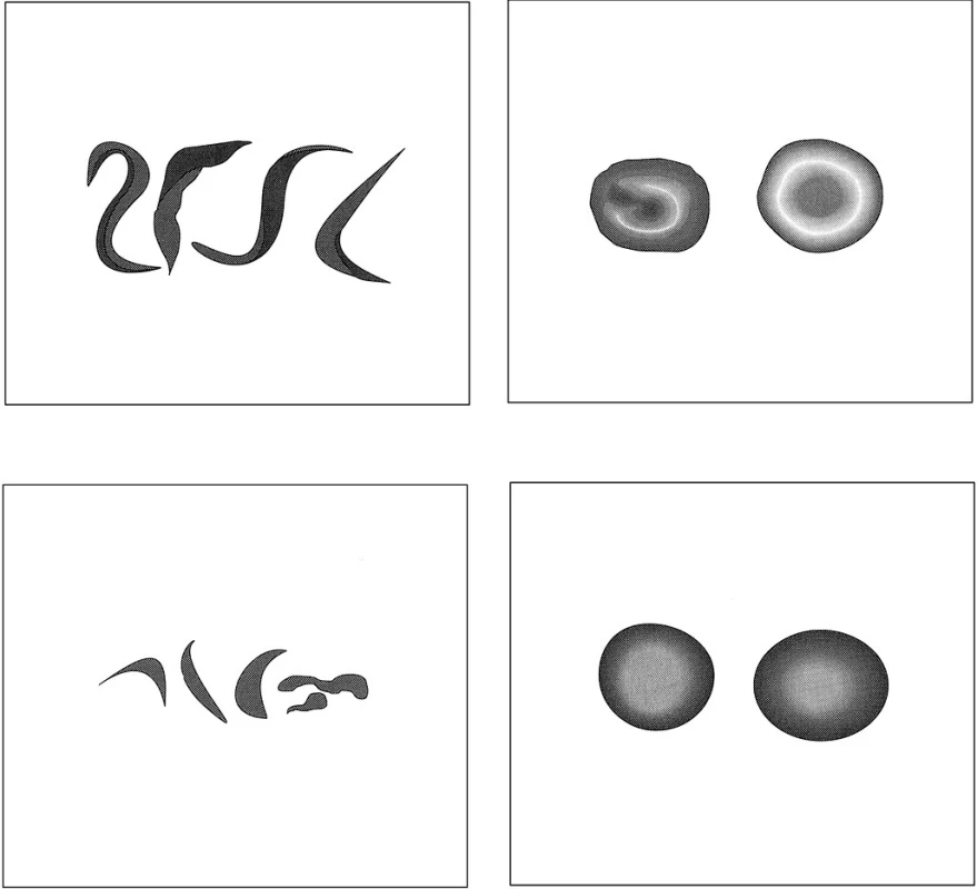 Tvary erytrocytů: a) srpkovité erytrocyty u srpkovité anemie; b) terčovité erytrocyty u talasémie; c) schistocyty u trombotické trombocytopenické purpury či diseminované intravaskulární koagulace; d) normální tvar erytrocytu.