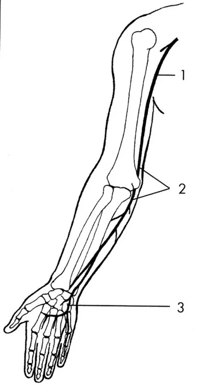 N. ulnaris – místa komprese.
1 – v axile,
2 – v širší oblasti lokte,
3 – na zápěstí a v dlani.