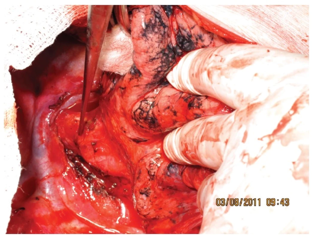 Peroperační nález – pravý hlavní bronchus s nádorem
Fig. 2: Intraoperative view – right main stem bronchus with the tumour inside