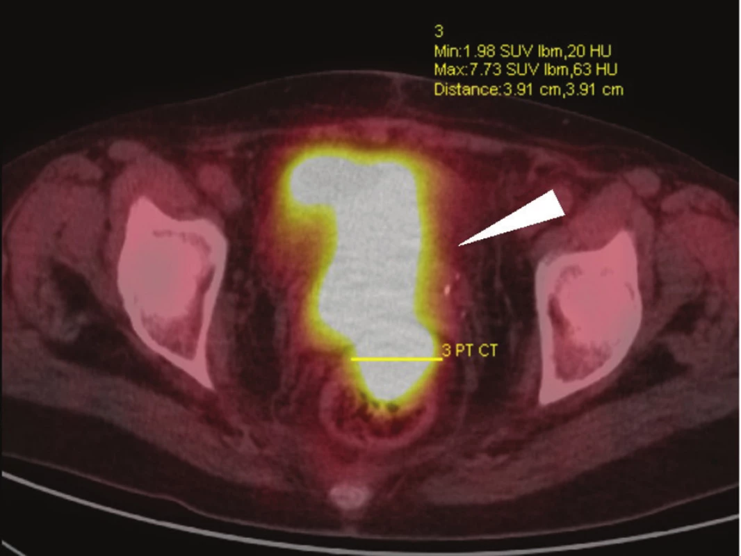 PET/CT vyšetření, axiální skeny: rozsáhlý tumor malé pánve, postihující rektum, pochvu a močový měchýř (bílá šipka) – předoperační vyšetření u stejné nemocné jako na Obr. 1.
Fig. 2: PET/CT, axial scans: extensive tumour of the small pelvis, invading the rectum, vagina and urinary bladder (white arrow) – preoperative assessment in the same patient as in Fig. 1.