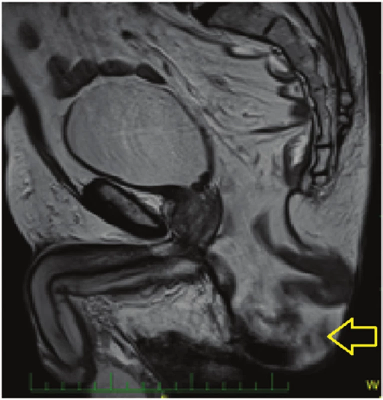 Perineální kýla - MRI nález
Fig. 2: Perineal hernia – MRI image