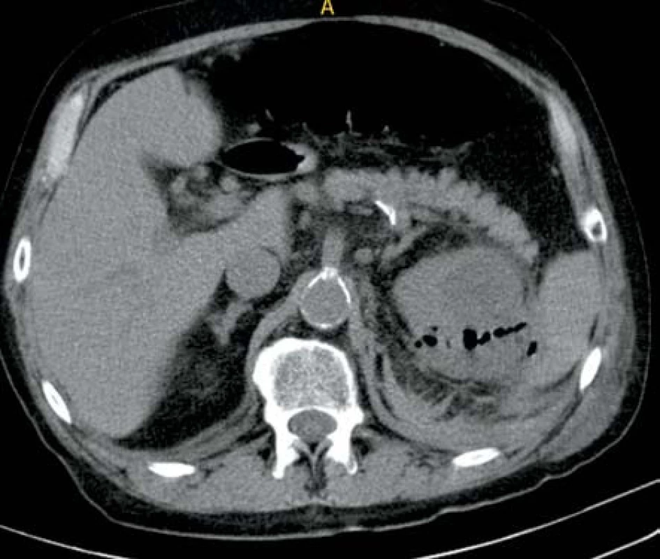 Ledvinný absces levé ledviny s mnohočetnými ložisky plynu
Fig. 5. Abscess in left kidney with multifocal gas deposits