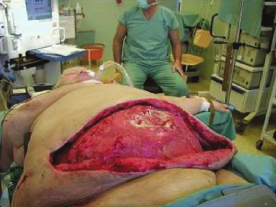 Nekrotizující infekce ve stadiu hojení po opakované chirurgické revizi