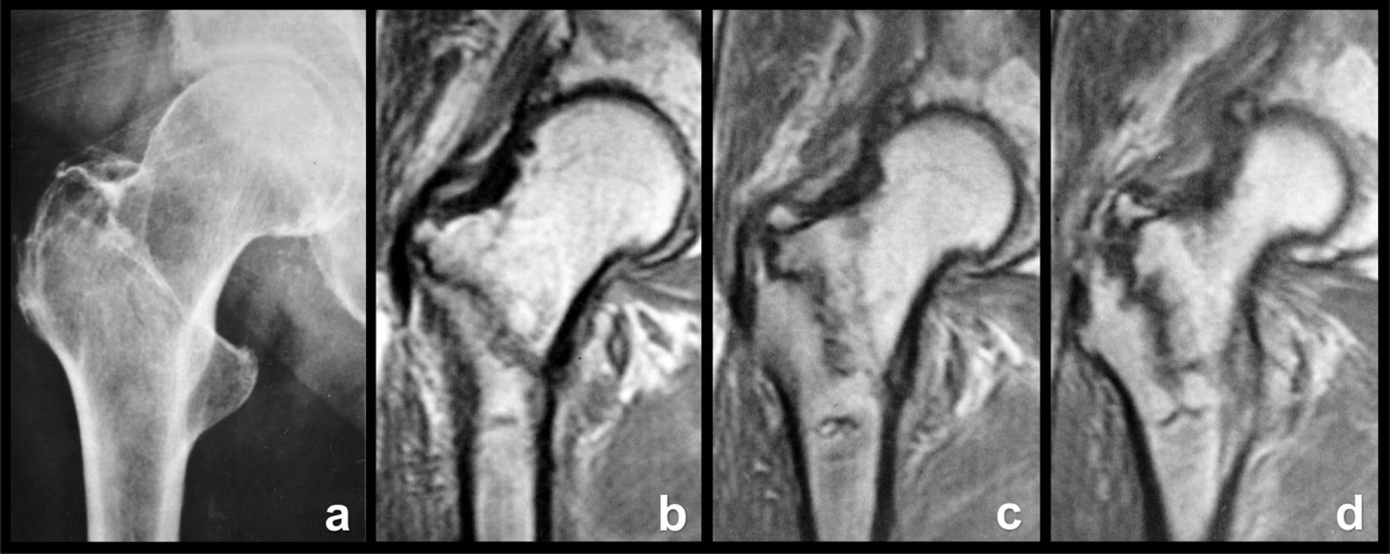 Okultní pertrochanterická zlomenina: a – rtg snímek, lomná linie není patrná; b – frontální MR řez ventrální částí proximálního femuru, lomná linie dosahuje až k malému trochanteru; c – frontální MR řez střední částí proximálního femuru, inkompletní lomná linie probíhá vertikálněji; d – frontální MR řez dorzální částí proximálního femuru, je patrné odlomení apexu velkého trochanteru i komprese spongiózy podél lomné linie. 
Fig. 10: Occult pertrochanteric fracture: a – radiograph, fracture line cannot be seen; b – frontal MRI section through the anterior part of the proximal femur, the fracture line extends as far as the lesser trochanter; c – frontal MRI scan through the middle part of the proximal femur, incomplete fracture line passes more vertically; d – frontal MRI scan through the posterior part of the proximal femur, both separation of the apex of the greater trochanter and compression of the cancellous bone along the fracture line can be seen.