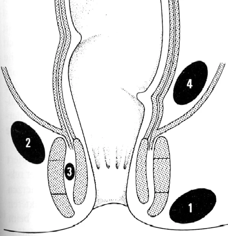 Typy perianálních abscesů
1 – subkutánní, 2 – ischiorektální, 3 – intersfinkterický, 4 – pelvirektální
Fig. 1: Types of perianal abscess
1 - subcutaneous 2 - ischiorectal 3 – intersphincteric, 4 – pelvirectal