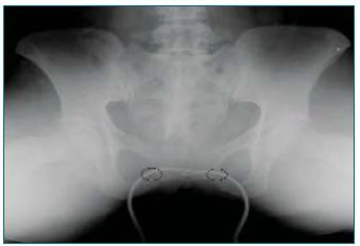 Rentgenový snímek zavaděčů procházejících předním obloukem obturatorního foramina.