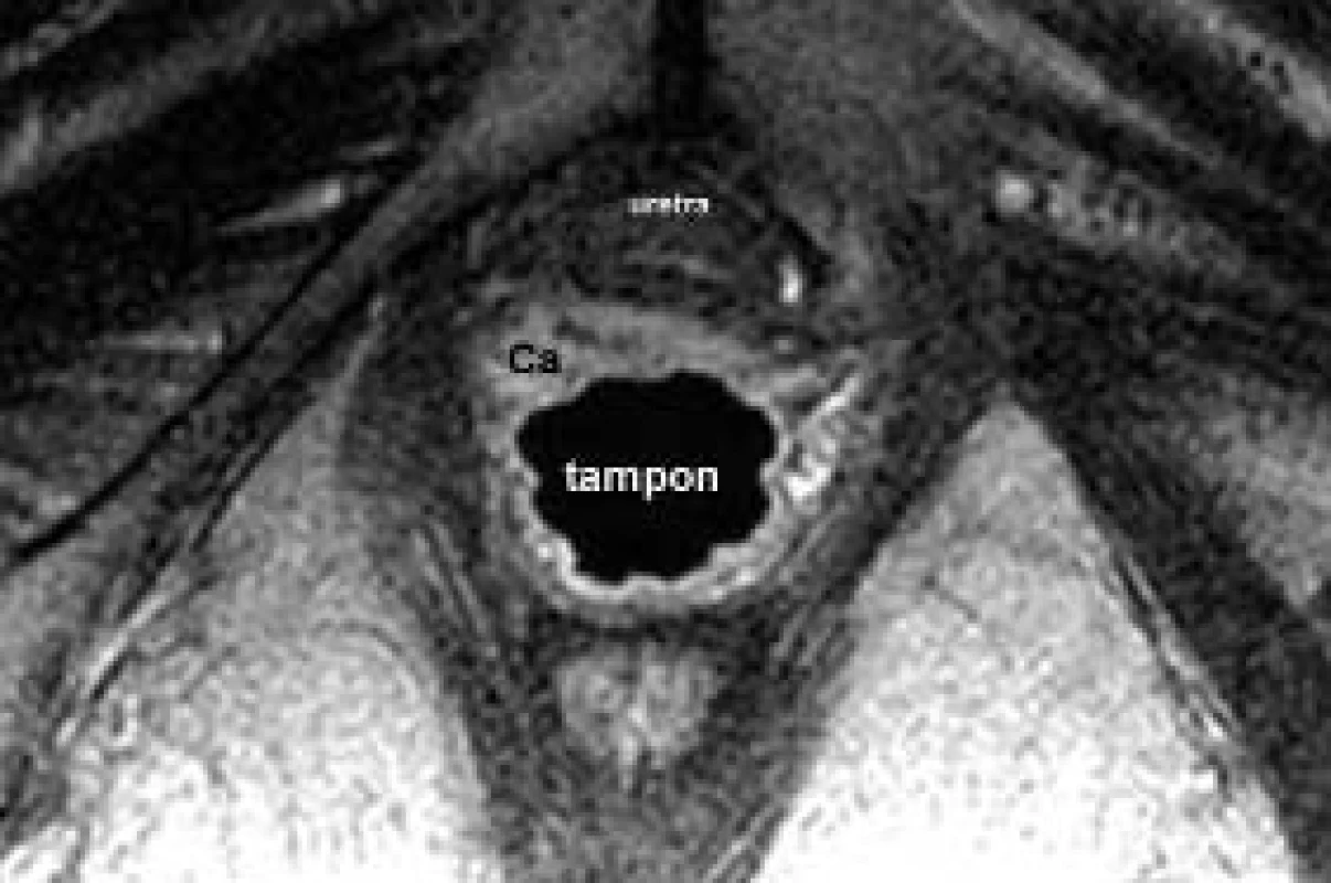 Karcinom pochvy: na axiálním řezu je zjevná nádorová infiltrace přední stěny pochvy, asymetricky větší vpravo, a její vztah k uretře.