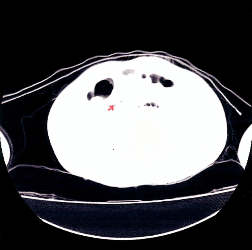 CT snímek – pneumoretroperitoneum (plicní okno)
Fig. 4. CT view – pneumoretroperitoneum (pulmonary view)