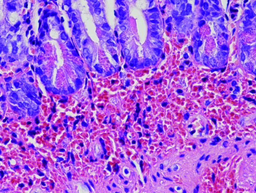 Biopsia patologicky zmenenej sliznice duodena – histopatologický obraz (farbenie HE).
Fig. 3. Biopsy of pathologically altered mucosa of the duodenum – histopathological image (HE colouring).