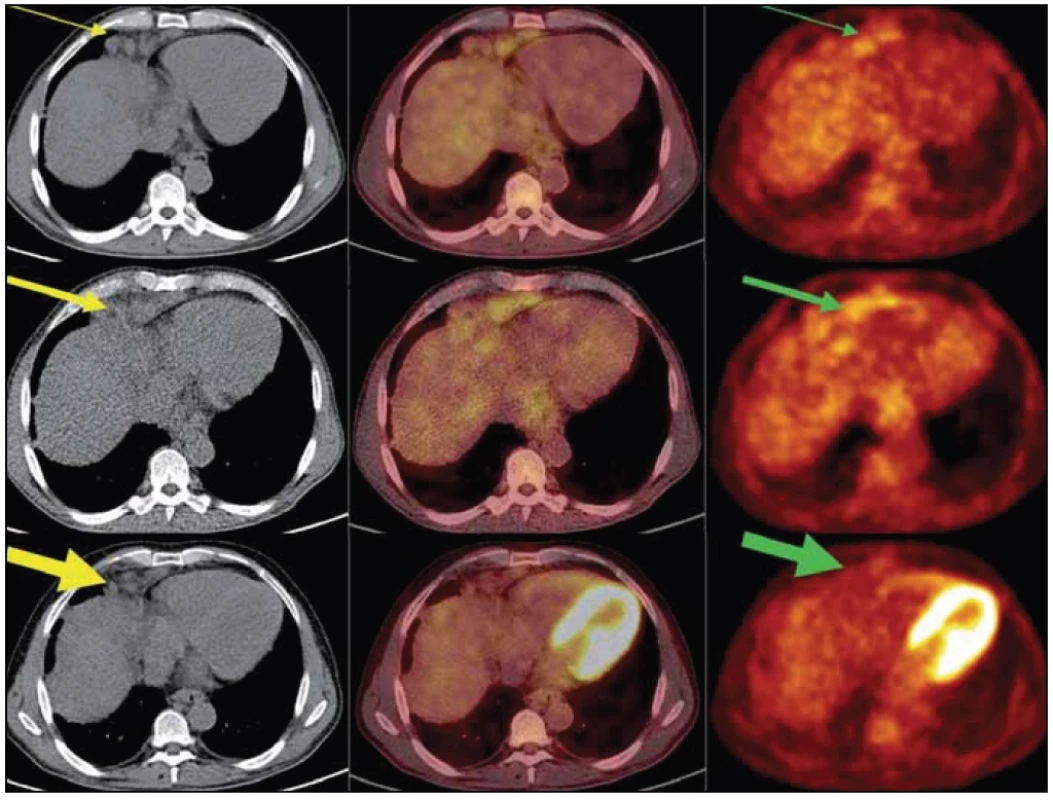PET/ CT vyšetření: obrazy CT (vlevo), PET- CT (uprostřed) a PET (vpravo) v axiálním řezu v úrovni uzlinového paketu v bráničním úhlu ventrálně vpravo.