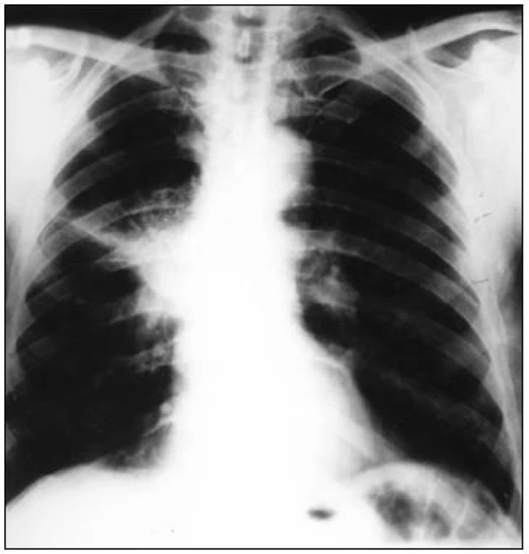 RTG pľúc v PA projekcii – diagnóza epidermoidný ZN pľúc vpravo z ionizujúceho žiarenia