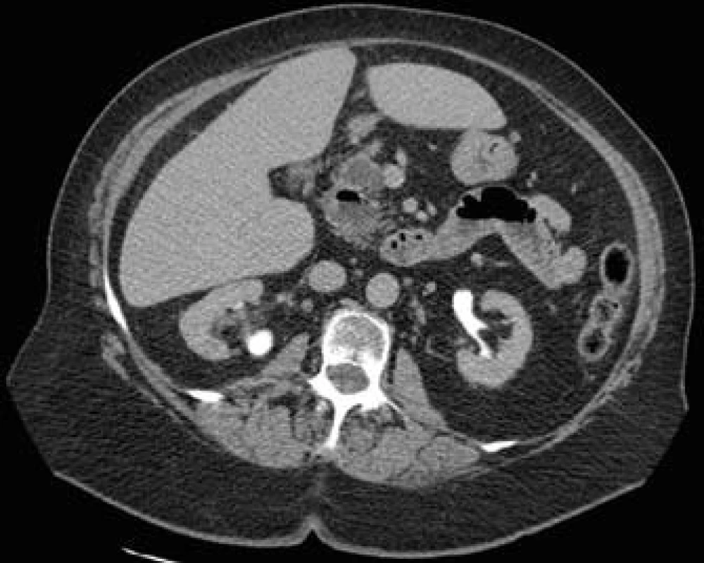 CT snímok brucha: nádor v hlave pankreasu s priemerom 23 mm.
Fig. 1. Abdominal CT scan: pancreatic head tumor with a diameter of 23 mm.