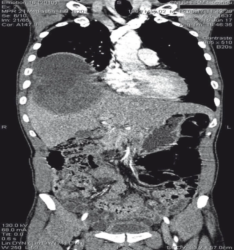 Thoracoabdominal scan (frontal cut) showing the fi stula through the diaphragm connecting a large hepatic dome abscess and right basal pulmonary abscess.<br>
Obr. 2. Snímek hrudníku a břicha (frontální řez) s nálezem fistuly vedoucí přes bránici
a spojující absces ve velkém jaterním laloku a výchozí pravostranný plicní
absces.