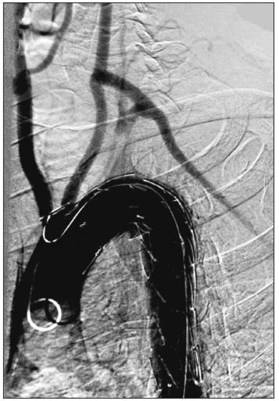 54-ročný muž s aneuryzmatickou dilatáciou anomálne odstupujúcej arteria subelavia dextra (arteria lusoria). Stav po implantácii hrudného stentgraftu do oblasti aortálneho oblúka a dodilatovaní stentgraftu. Digitálna subtrakčná angiografia aortálneho oblúka a supraaortových vetiev.
Fig. 5. A54-year old male with aneurysmal dilatation of an abnormal arteria subclavia dextra (arteria lusoria). Following thoracic stentgraft implantation into the aortic arch region and completion of the stentgraft dilation. Digital subtraction angiography of the aortic arch and supraaortic branches.