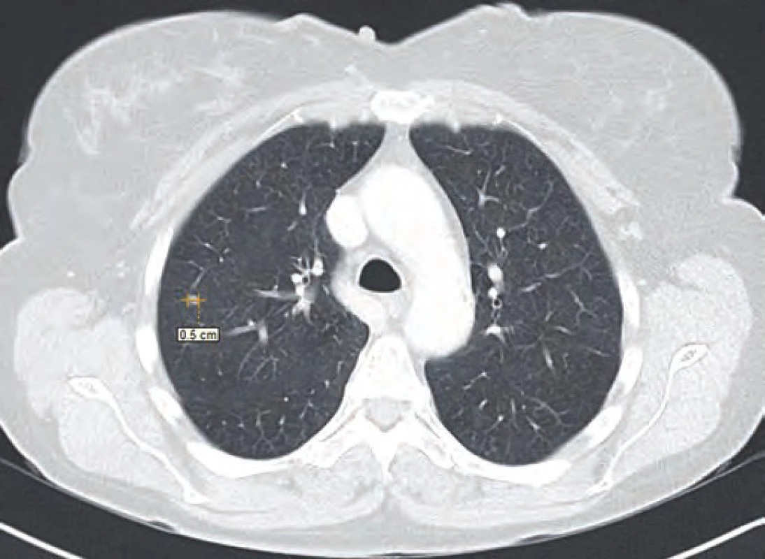 CT řez plic ze srpna 2014.