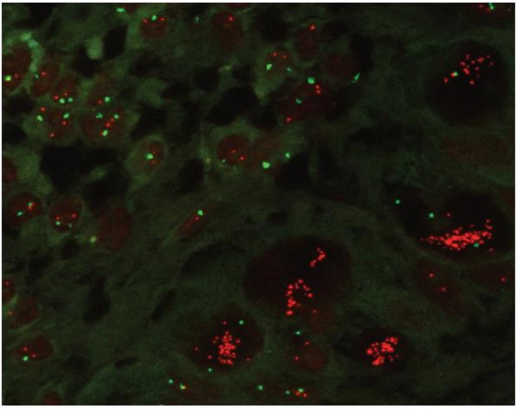 Morfologický přehled při vyšetření I-FISH v histologickém řezu.
I-FISH umožňuje zhodnotit nález v nádorové populaci karcinomu mléčné žlázy s amplifikací genu ERBB2 (pravá dolní část obrázku) a v okolní tkáni (levá horní část obrázku). Směs dvou sond ERBB2 (Spectrum Orange), CEP17 (centromera chromozomu 17 – Spectrum Green); (Vysis).
