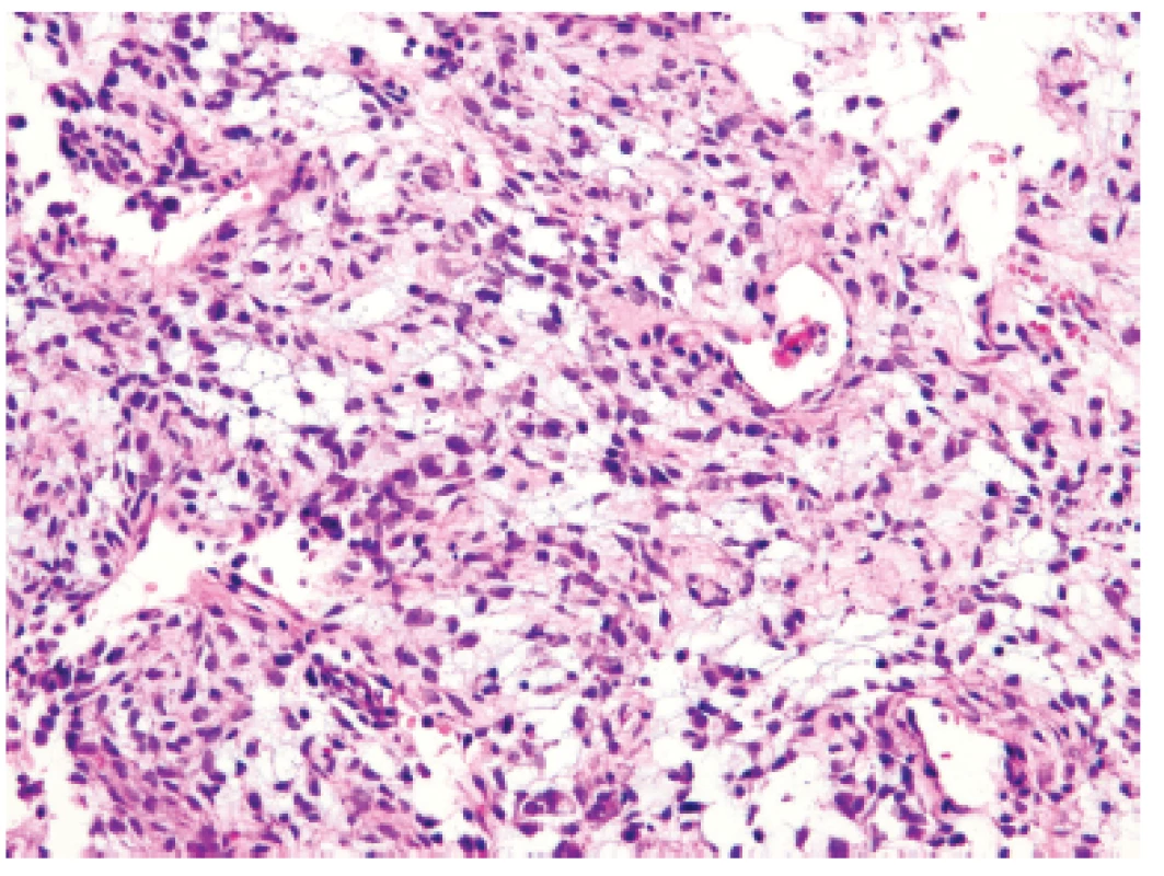 Kazuistika &lt;b&gt;2&lt;/b&gt;. Místní výrazná myxoidní přeměna nádoru vytvářela dojem nevinné hypocelulární léze s malými oválnými jádry bez pleomorfizmů (HE, 400x).
