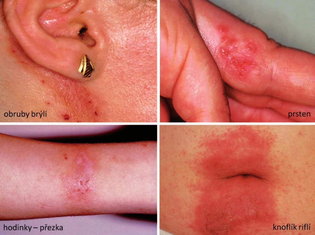 Eczema contactum – nikl