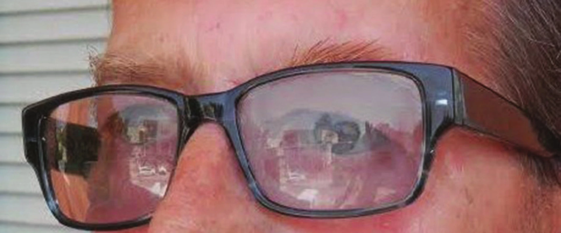 Epitéza upevnená na rám okuliarov