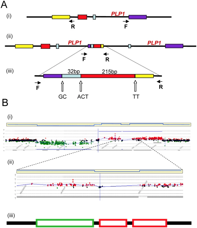 Complex rearrangements involving <i>PLP1</i> detected by junction analysis (A) and oligonucleotide array comparative genomic hybridization analysis (B) <em class=&quot;ref&quot;>[22]</em>.