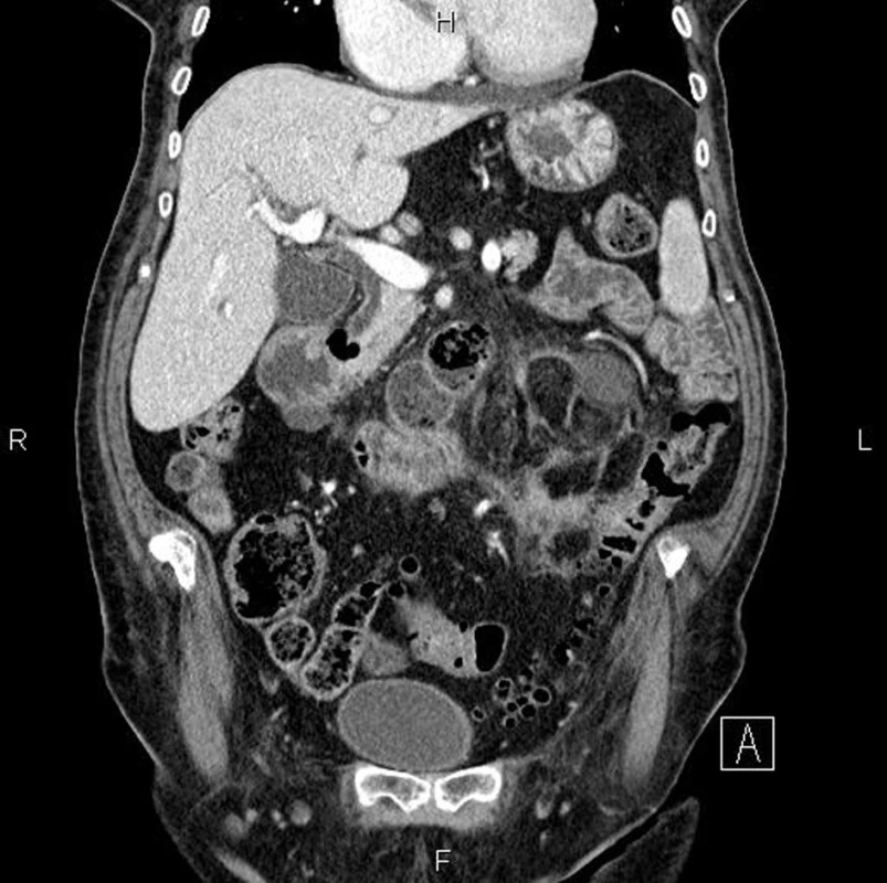 CT vyšetření: nepravidelné zesílení stěny colon descendens při tumorózní infiltraci v terénu divertikulózy