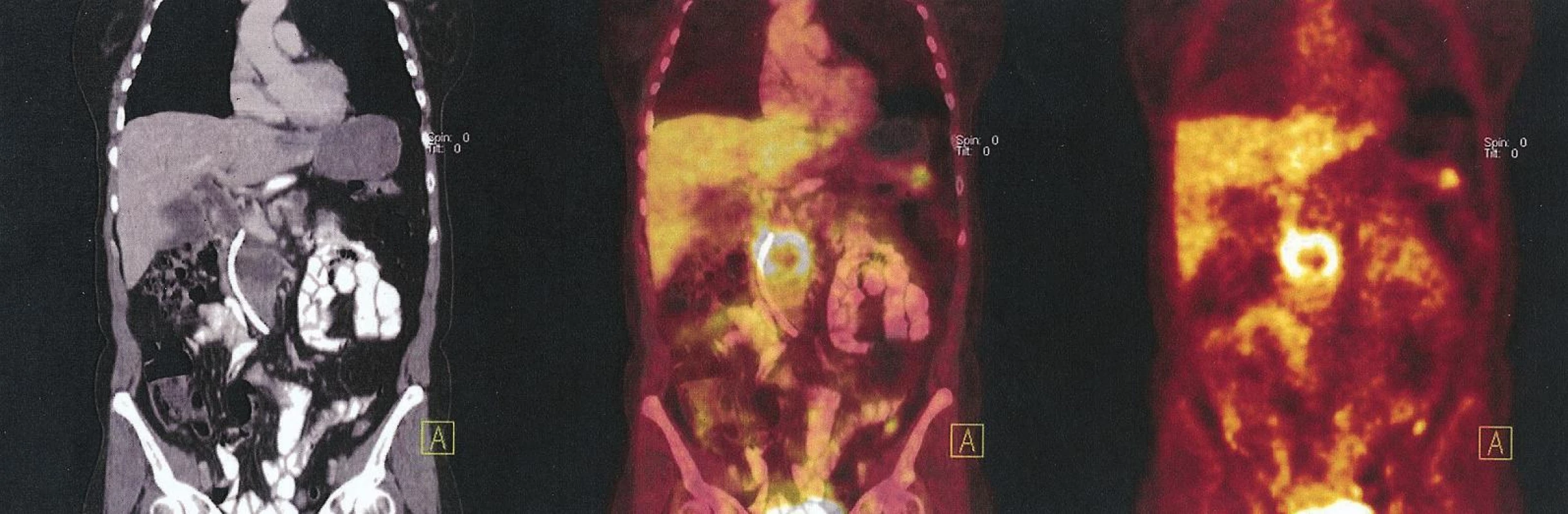Benigní cystadenom kaudy pankreatu. V CT fázi ložisko v kaudě, bez korelátu v PET fázi
Fig. 3. Benign cystadenoma of the cauda. The CT phasebearing in the cauda without correlate on the PET phase