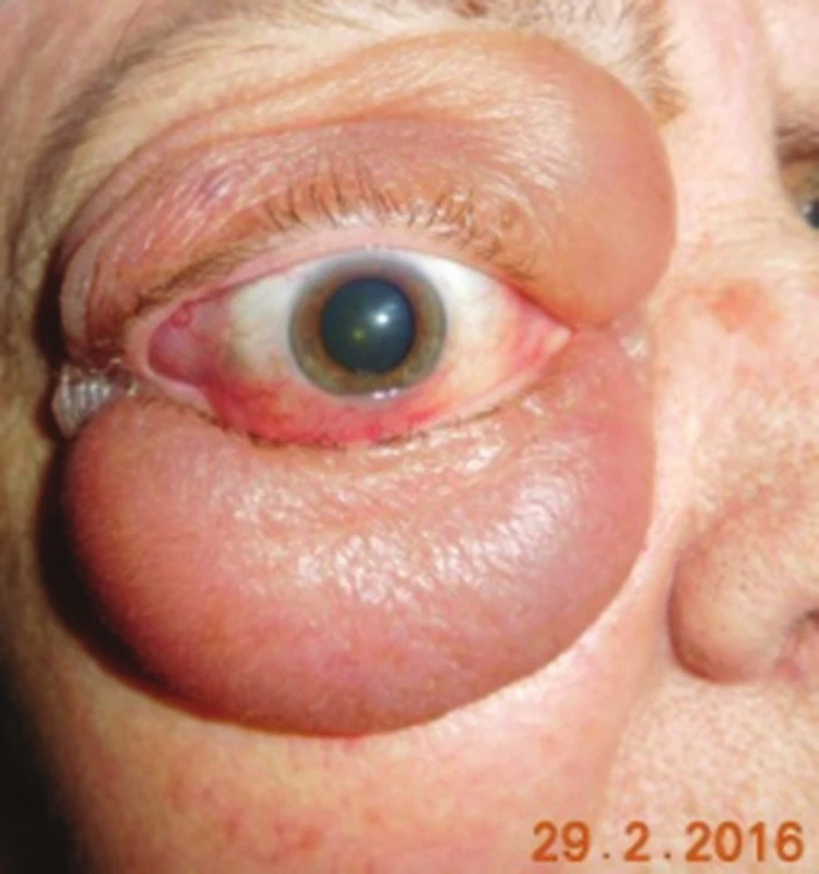 Typický obraz infiltrácie mäkkých tkanív očnice pri lymfómovom ochorení