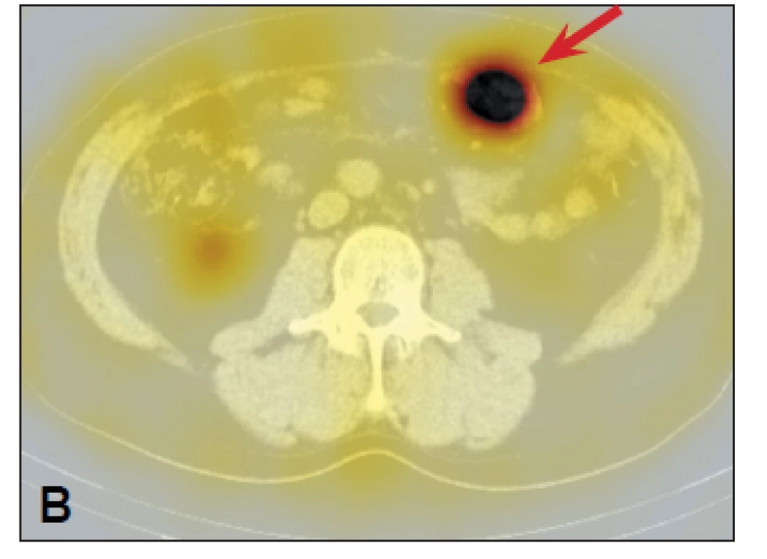 <i>SPECT/CT obrazy s Octreoscanem – zvýšená akumulace v levém mezogastriu ventrálně.</i>