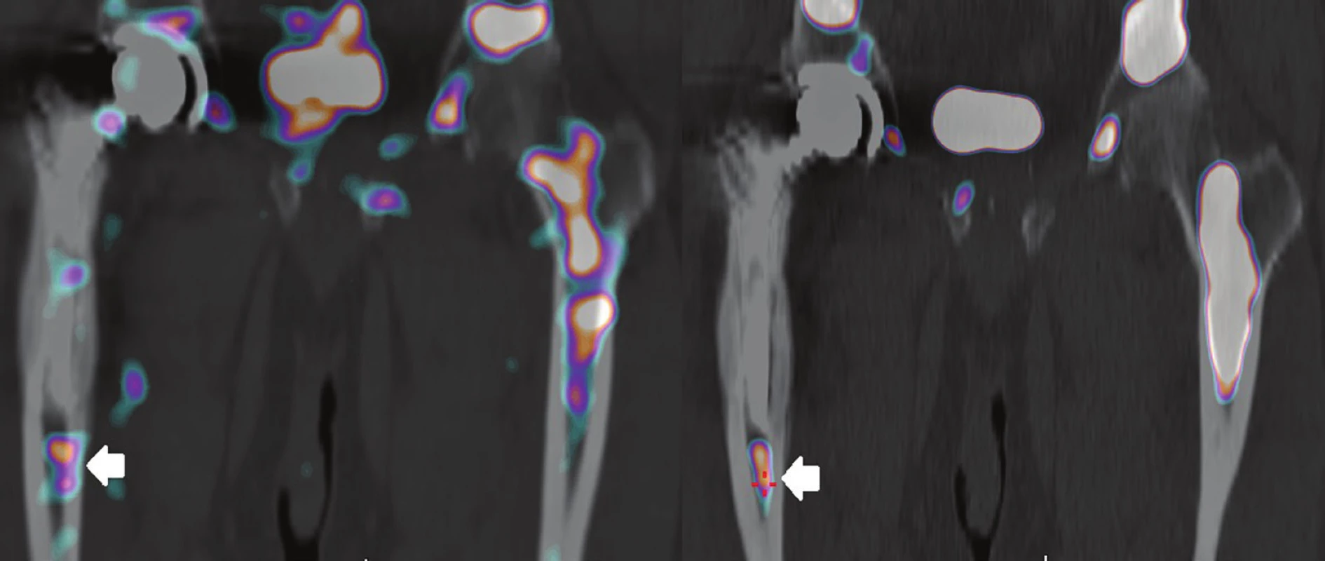 <i>Srovnání vyšetření značenými leukocyty, pozdní snímek za 24 hod (vlevo), s vyšetřením fagocytující kostní dřeně (vpravo).</i>