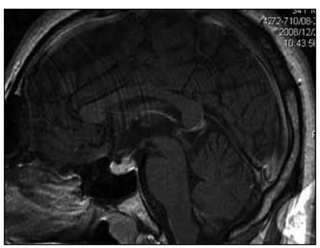 Sagitální rovina MR zobrazení mozku před zahájením léčby, T1 vážený MR obraz po aplikaci k.l. Je zřetelná ložisková sytící se infiltrace stopky hypofýzy.