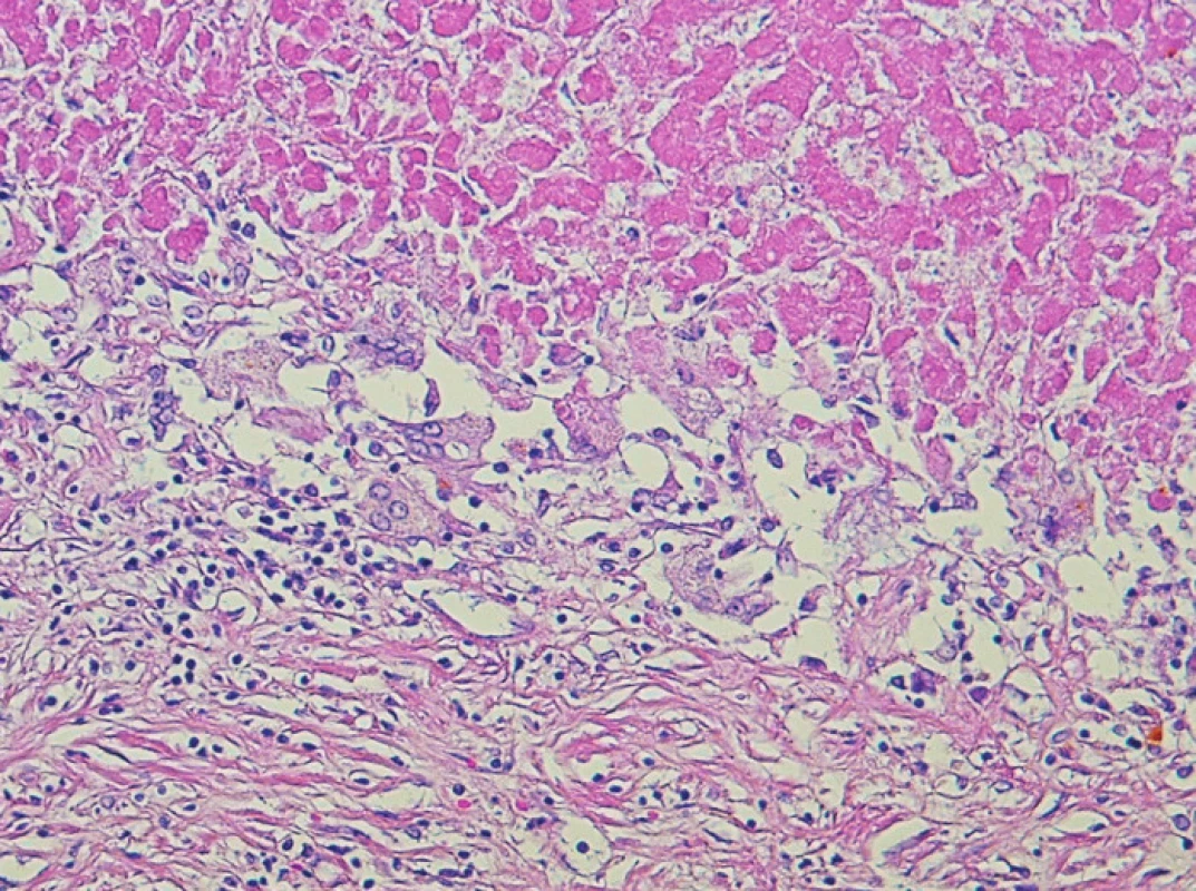 Detail rozhraní nekrotického nádoru a přilehlého vaziva. Tkáň na nekrózu reaguje obrovsko-buněčnou reakcí, která je součástí regresivně reparativních změn a zahrnuje resorpci nekrotických hmot s ohraničením ložiska (200x, H&amp;E)
Fig. 5. A detail view of the boundary between the necrotic tumor and the adjacent fibrous tissue. The necrosis produces a giant-cell reaction within the tissue, which is a part of the reparative changes and includes resorption of the necrotic tissue with the focus demarkation (200x, H&amp;E)