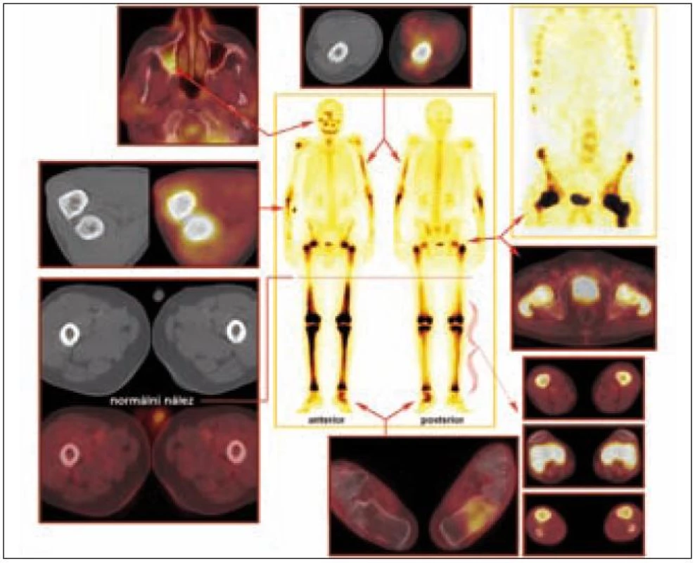 Srovnání nálezů z PET, PET/CT, klasické kostní scintigrafie a SPECT vyšetření u pacienta s Erdheimovou-Chesterovou chorobou.

Celotělová scintigrafie skeletu (uprostřed) a SPECT (vpravo nahoře): Abnormální akumulace radiofarmaka v oblasti hlavy vpravo (zygomatický oblouk, frontální oblast a mandibula), v oblasti horních končetin (střední část levé pažní kosti, proximální části vřetenních kostí oboustranně a v pravém ramenním kloubu) a dále i v oblasti dolních končetin (proximální třetina a distální polovina obou stehenních kostí, obě kosti holenní a kost hlezenní a patní vlevo).

PET a PET/CT: Diskrétní rozšíření a struktura s vyšší denzitou dorzální části laterální stěny dolní poloviny pravého maxilárního sinu, méně nápadný nález také v dorzální části mediální stěny ve stejné etáži. Stejný charakter změn zasahuje kaudálně až do dorzální části alveolárního výběžku maxily vpravo. Výše popsané změny mají pozitivní korelát v PET obraze. Na bázi pravého maxilárního sinu je minimální měkkotkáňový lem.

Výrazně sklerotická struktura skeletu je prostoupena osteolytickými okrsky, v úsecích diafýz je patrné zesílení kompakty, rovněž se zobrazila patologická struktura dřeňové dutiny se zvýšením denzity tkáně v okrajích. Patologická struktura je v oblasti horních končetin (převážná část levého humeru pouze s vynecháním proximální části, v pravém humeru naopak okrsek patologické struktury v oblasti hlavice a v blízkosti loketního kloubu, z větší části je postižena ulna a radius oboustranně s maximem změn v proximálních úsecích) a v oblasti dolních končetin (oba femory s vynecháním úseku asi střední třetiny diafýz, obě tibie, neúplně obě fibuly, vlevo výrazně kost patní, vpravo je v kosti patní jen nevýrazný okrsek při dolním okraji).