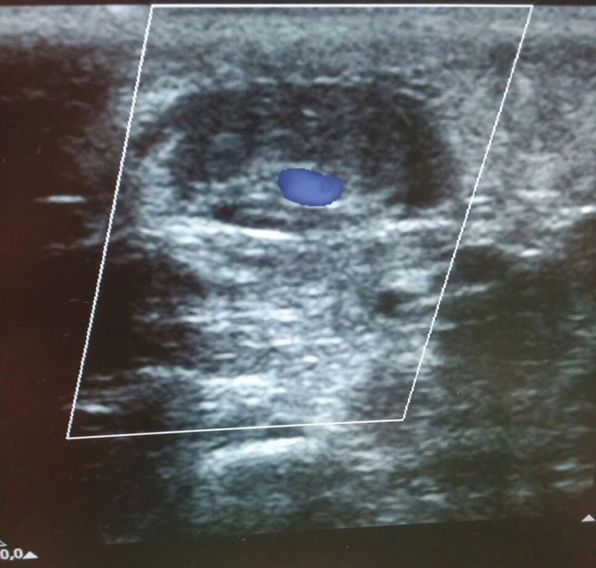 Ultrazvuková kontrola žíly po prvním podvazu s patrným malým reziduálním průtokem
Fig. 5:Ultrasound control of the vein after the first suture shows the presence of mild residual flow